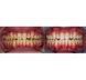 Заполненные гелем капы для домашнего отбеливания Ultradent Opalescence Go Дыня 10% ОТБ-11 фото 3