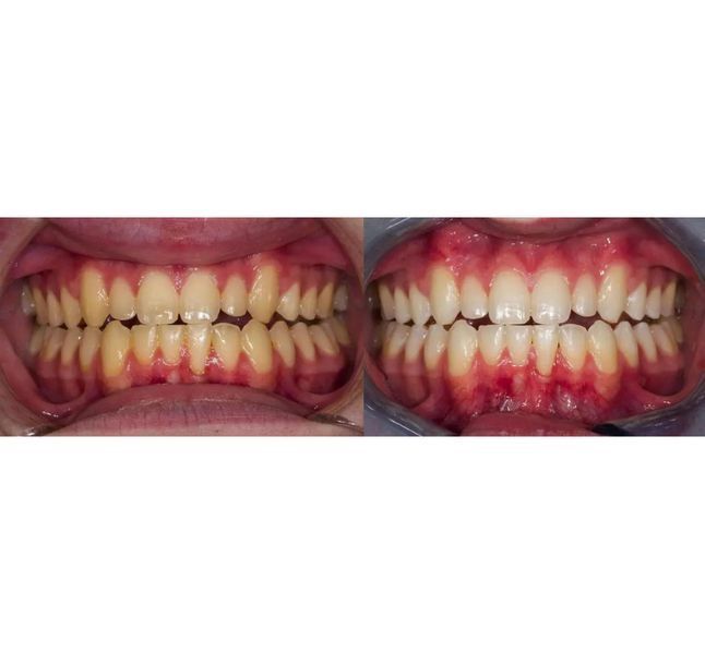 Заполненные гелем капы для домашнего отбеливания Ultradent Opalescence Go. Мята 6% ОТБ-13 фото