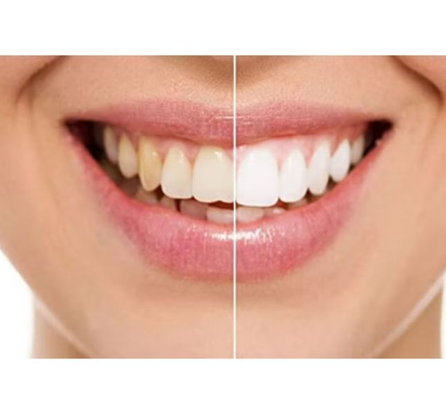 I Office 37.5%, Набір для кабінетного відбілювання зубів, 6 г картридж (Dengen Dental) ОТБ-35 фото