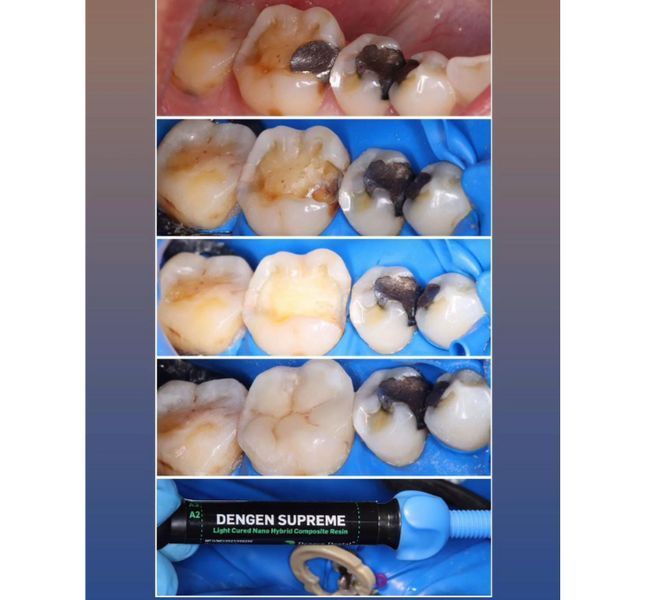 Dengen Supreme, Набір 7 шприців, Наногібридний композитний матеріал (Dengen Dental) ДЖД-2 фото