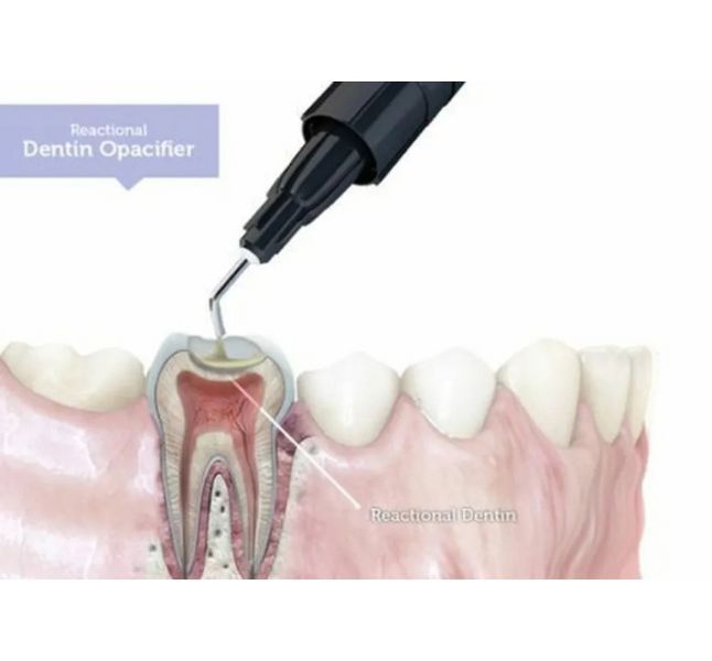 Dengocal LC, полімеризуючий світлом гідроксид кальцію, лайнер 2 г (Dengen Dental) ПМ-18 фото