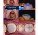 Dengen Supreme, Набір 7 шприців, Наногібридний композитний матеріал (Dengen Dental) ДЖД-2 фото 5