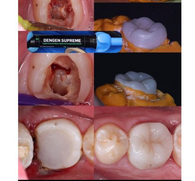 Dengen Supreme, Наногібридний композитний матеріал (Dengen Dental) UO ДЖД-3 фото