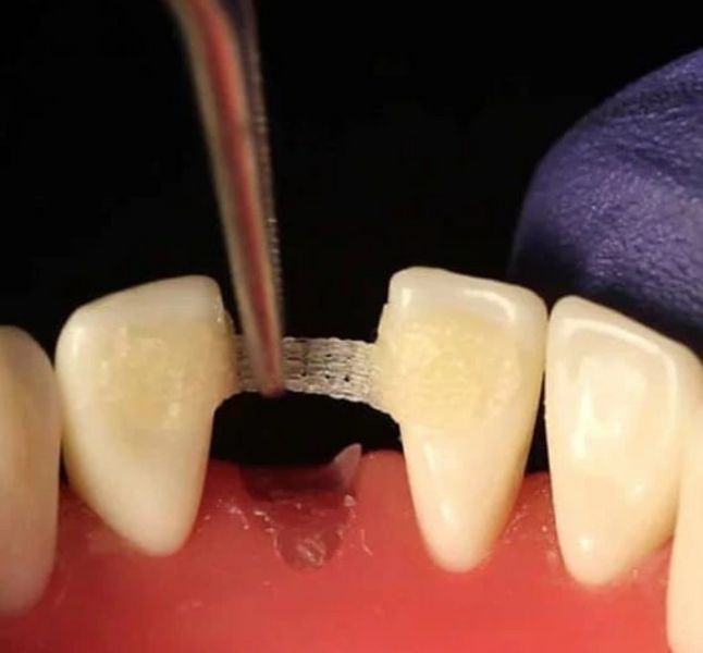 Укріплююча волокниста шина, Лента для шинування 76х2 мм (Dengen Dental) ШЛ-1 фото