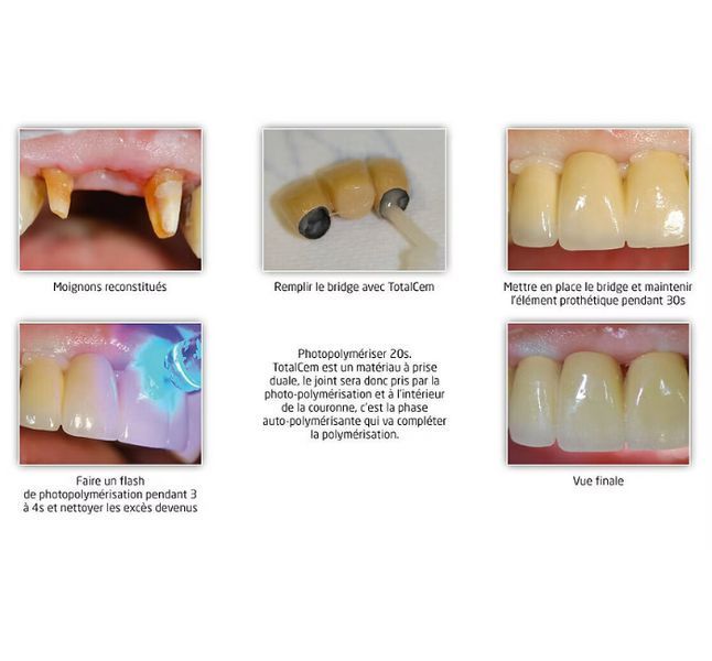 Dengen RMGI, цемент для фиксации двойного отверждения 9 г (Dengen Dental) ЦМ-102 фото